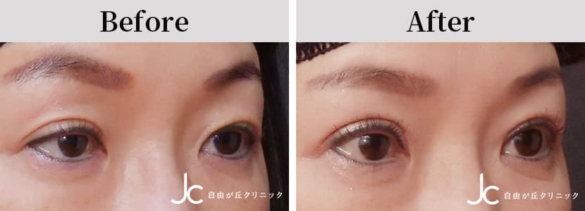 眼瞼下垂の症例写真