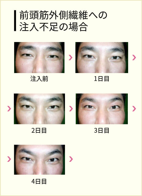 ヒアルロン酸 失敗 鼻 整形で顔面崩壊する人とは？高須克弥院長が明かす「失敗パターン5つ」