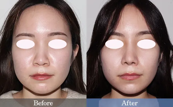 20代女性 Before / After