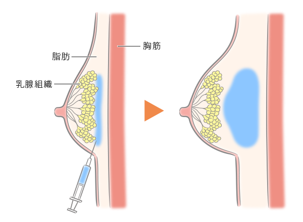 ヒアルロン酸豊胸注入 自由が丘クリニック 東京 美容外科 美容皮膚科