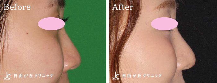 鼻尖形成術＋小鼻縮小の症例写真