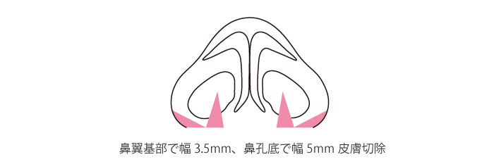 小鼻縮小術+鼻孔底（鼻翼幅）縮小術の症例写真