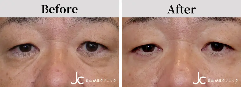 目の下のたるみ取りの症例写真
