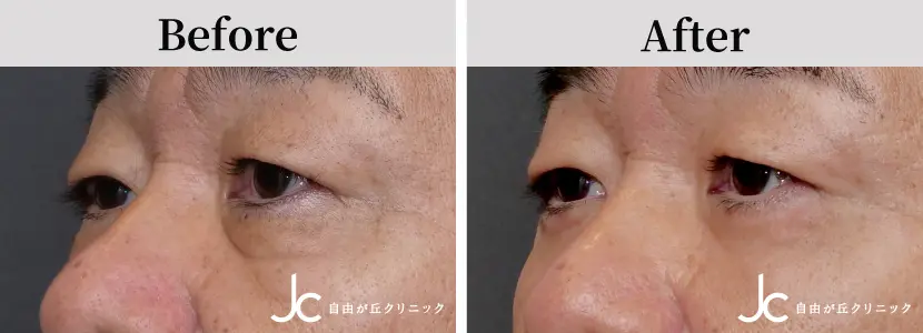 目の下のたるみ取りの症例写真