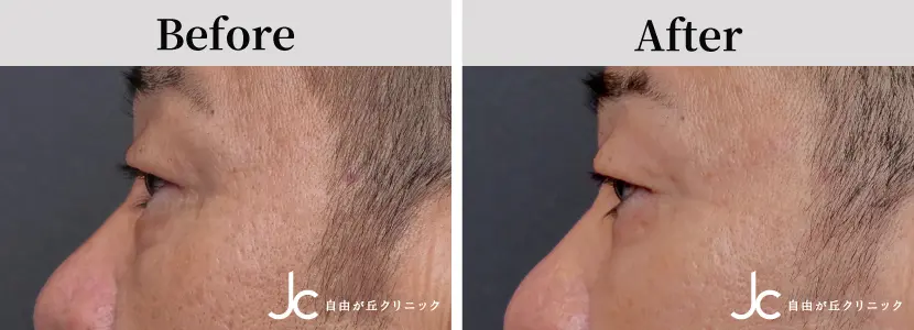 目の下のたるみ取りの症例写真