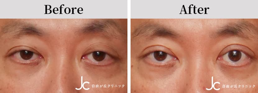 眼瞼下垂の症例写真