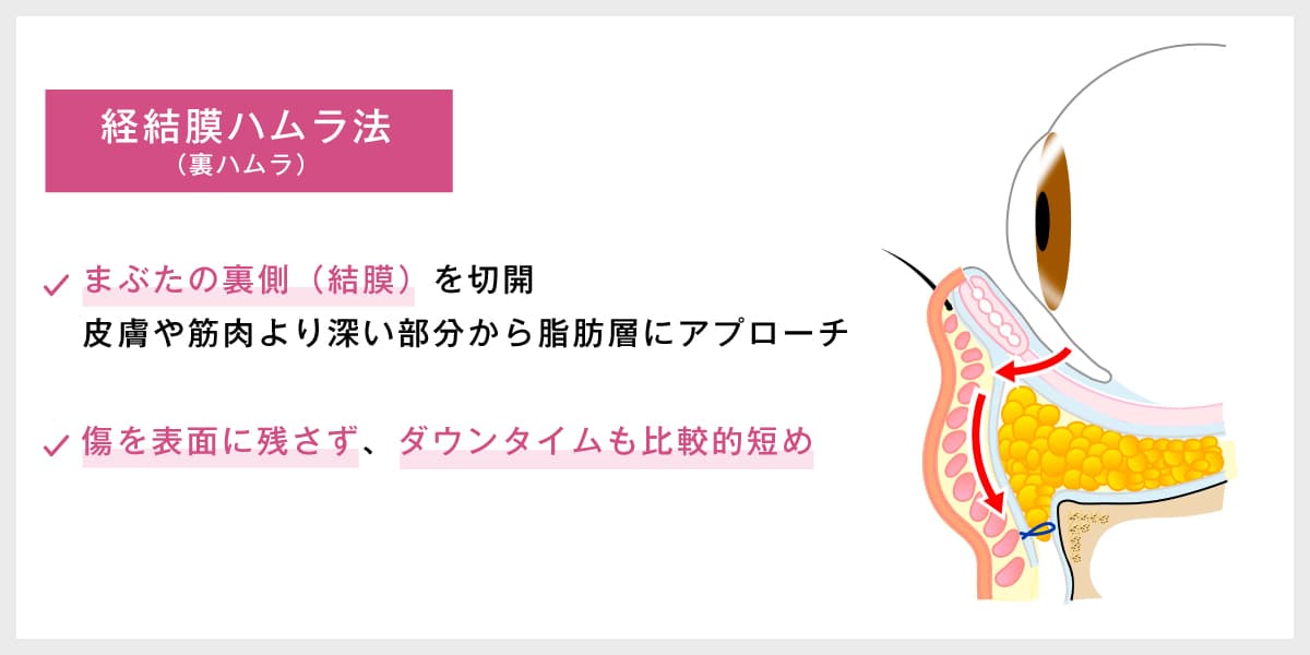 経結膜ハムラ法（裏ハムラ）