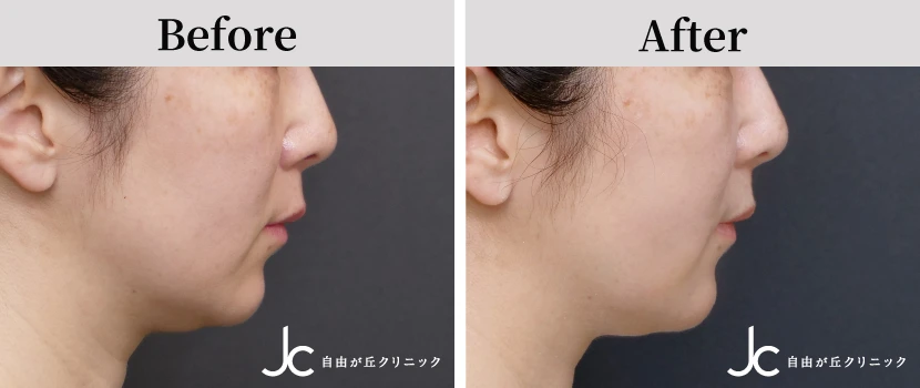 糸リフトの症例写真