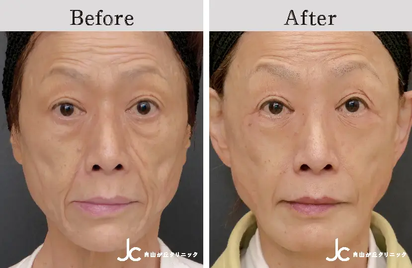 フェイスリフトの症例写真