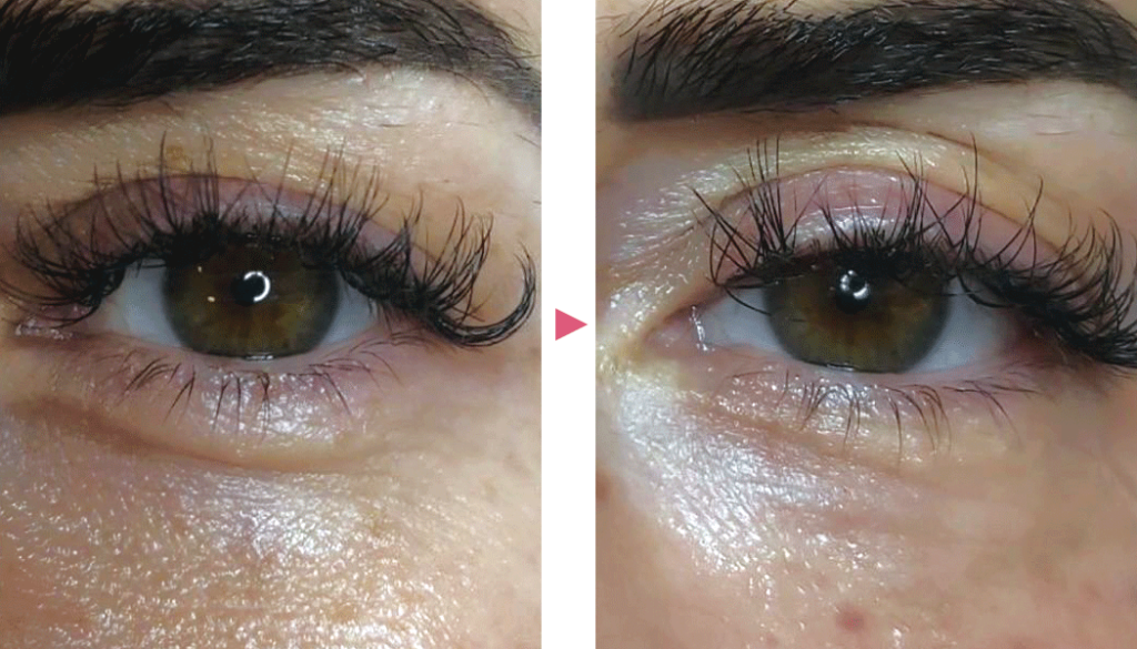 プルリアル シルク 自己細胞の再生に特化した新製剤 自由が丘クリニック 東京