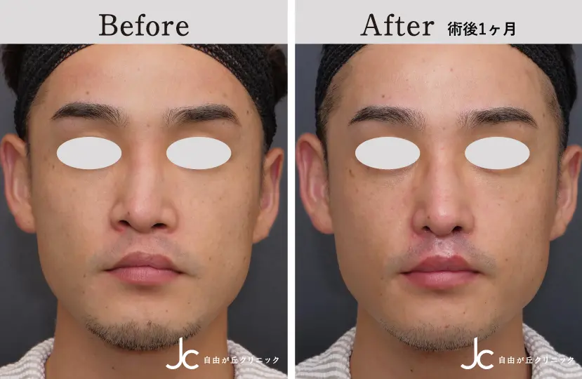 口唇裂の症例写真