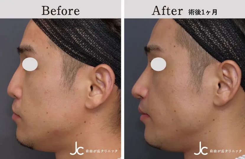 口唇裂の症例写真
