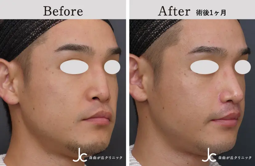 口唇裂の症例写真