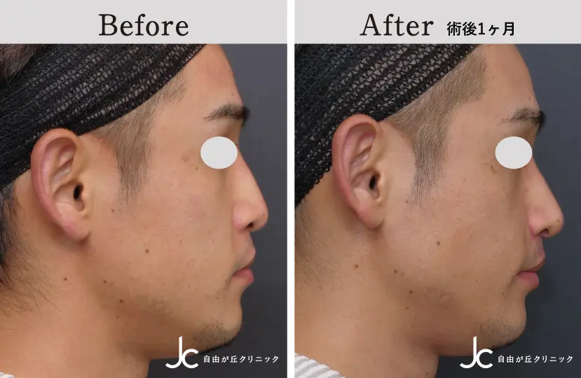 口唇裂の症例写真