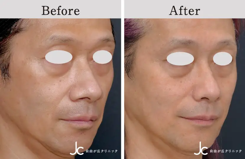 鼻の手術の症例写真