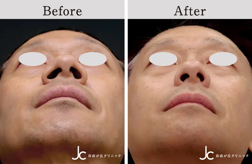 鼻の手術の症例写真