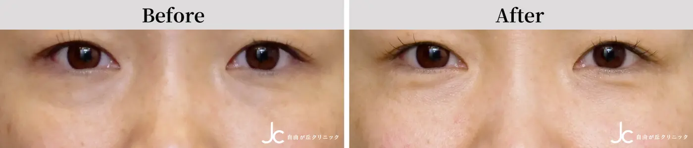 プルリアル デンシファイの症例写真