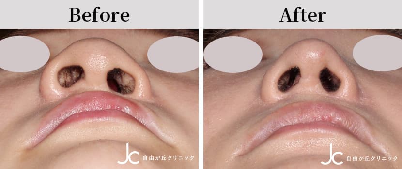 口唇裂術後の修正手術の症例写真