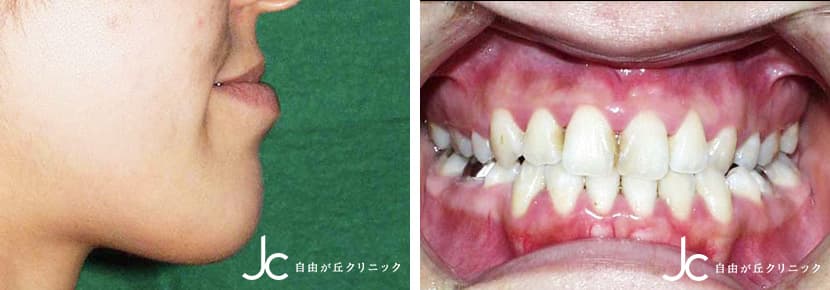 下顎手術の症例写真