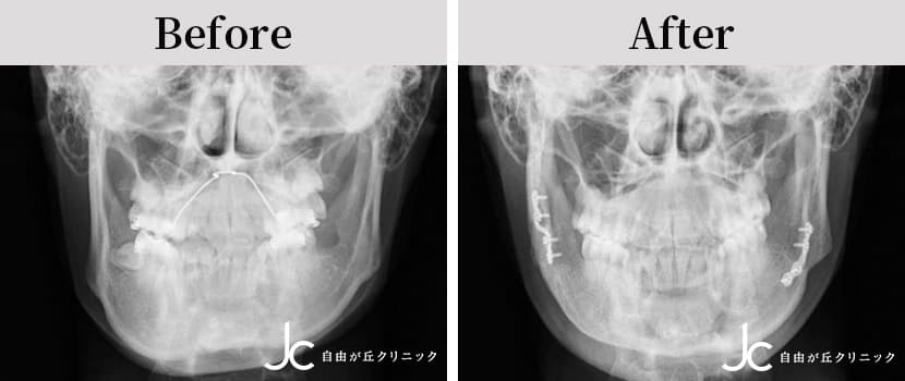 下顎手術の症例写真