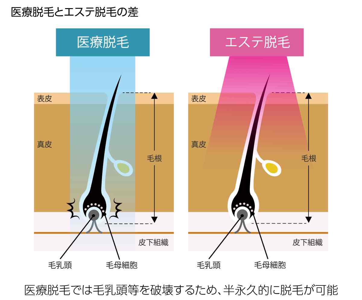 医療脱毛とエステ脱毛の差