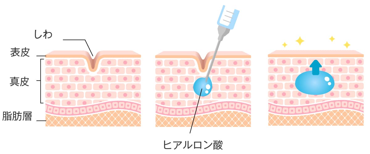 ヒアルロン酸注射の作用と仕組み