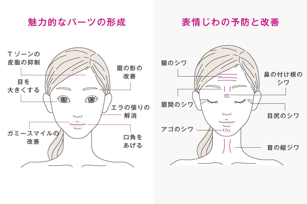 ボトックスで改善できること