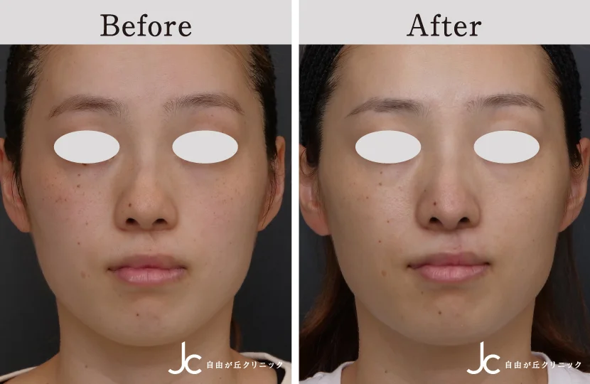 口唇裂の症例写真