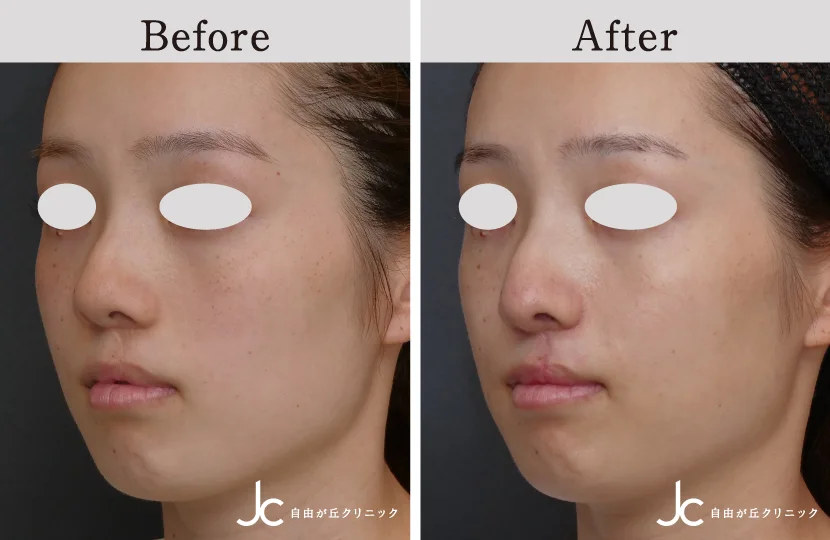 口唇裂の症例写真