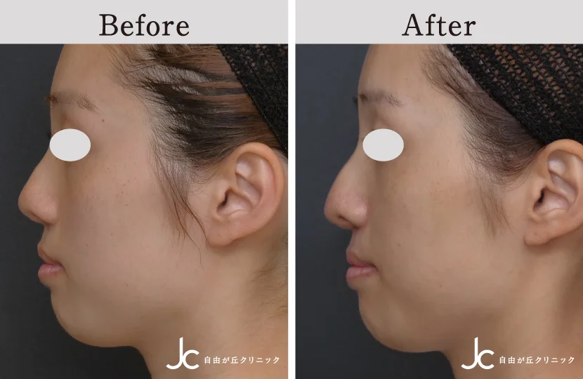 口唇裂の症例写真