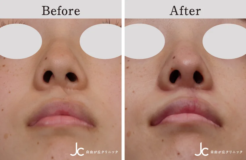 口唇裂の症例写真