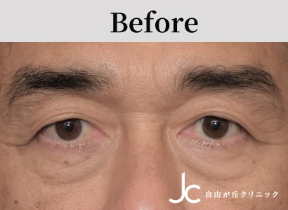 上まぶたのたるみ取りの症例写真