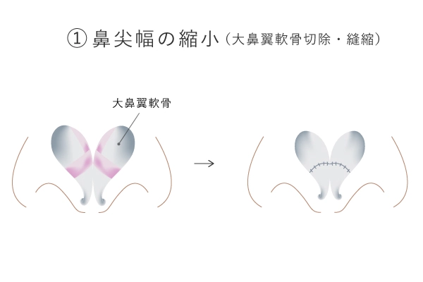 鼻尖幅の縮小図解イメージ