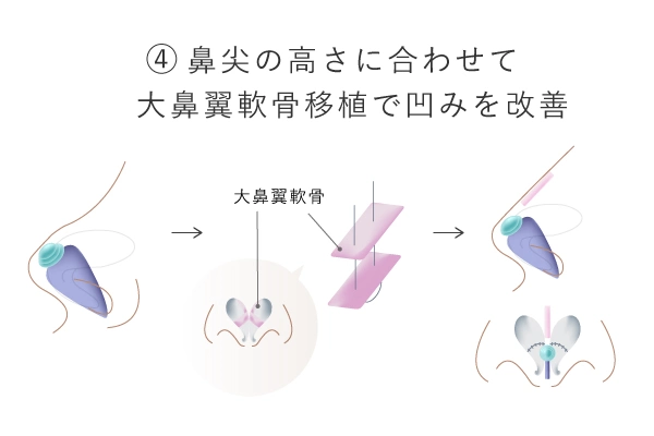 鼻尖上部に軽度の凹みが生じたため、先に切除した大鼻翼軟骨移植するイメージ画像
