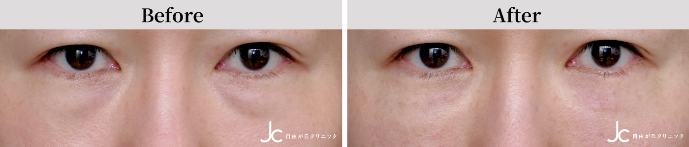 プルリアル デンシファイの症例写真