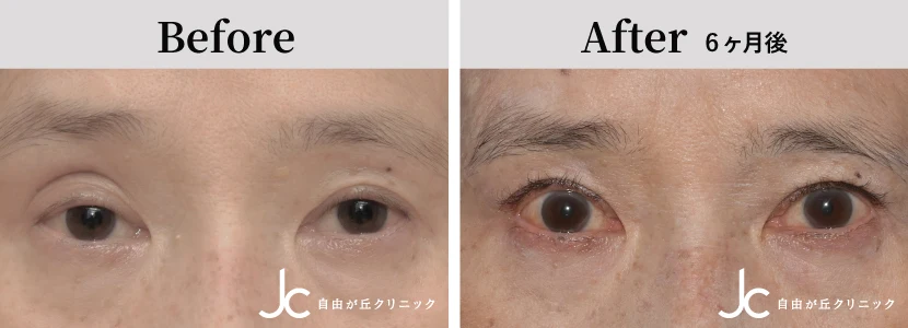 眼瞼下垂の症例写真