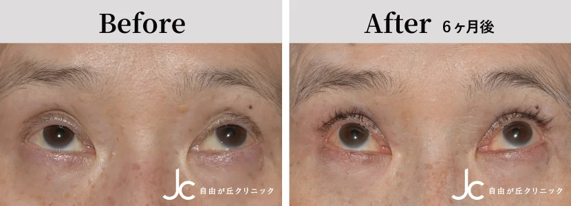 眼瞼下垂の症例写真