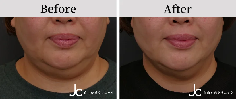 糸リフトの症例写真