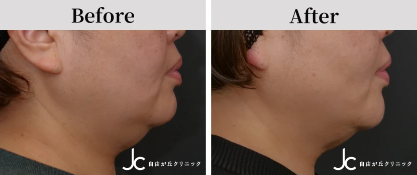 糸リフトの症例写真