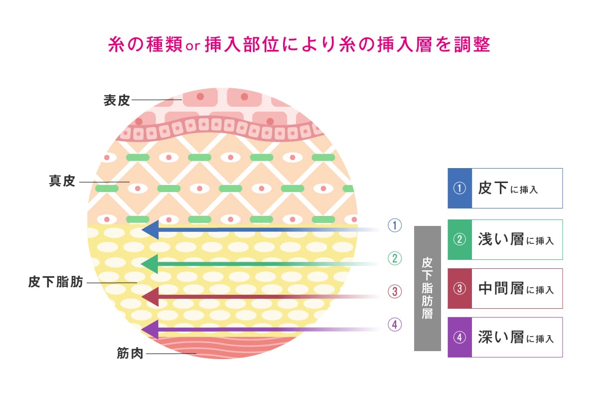 糸の種類、挿入部位によって糸の挿入層を調整