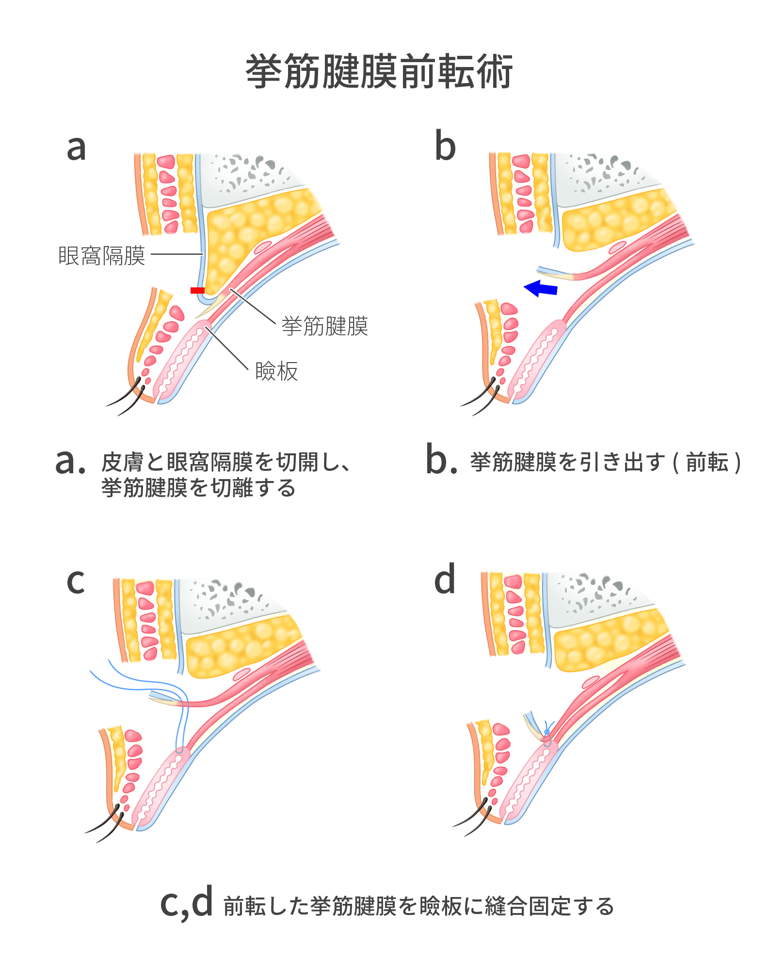 挙筋腱膜前転術の図解イラスト