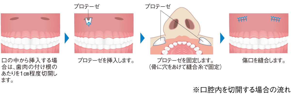 鼻翼基部形成術の流れ