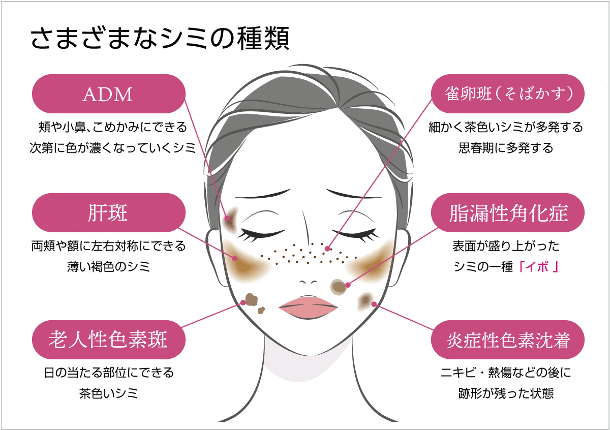 さまざまなシミの種類