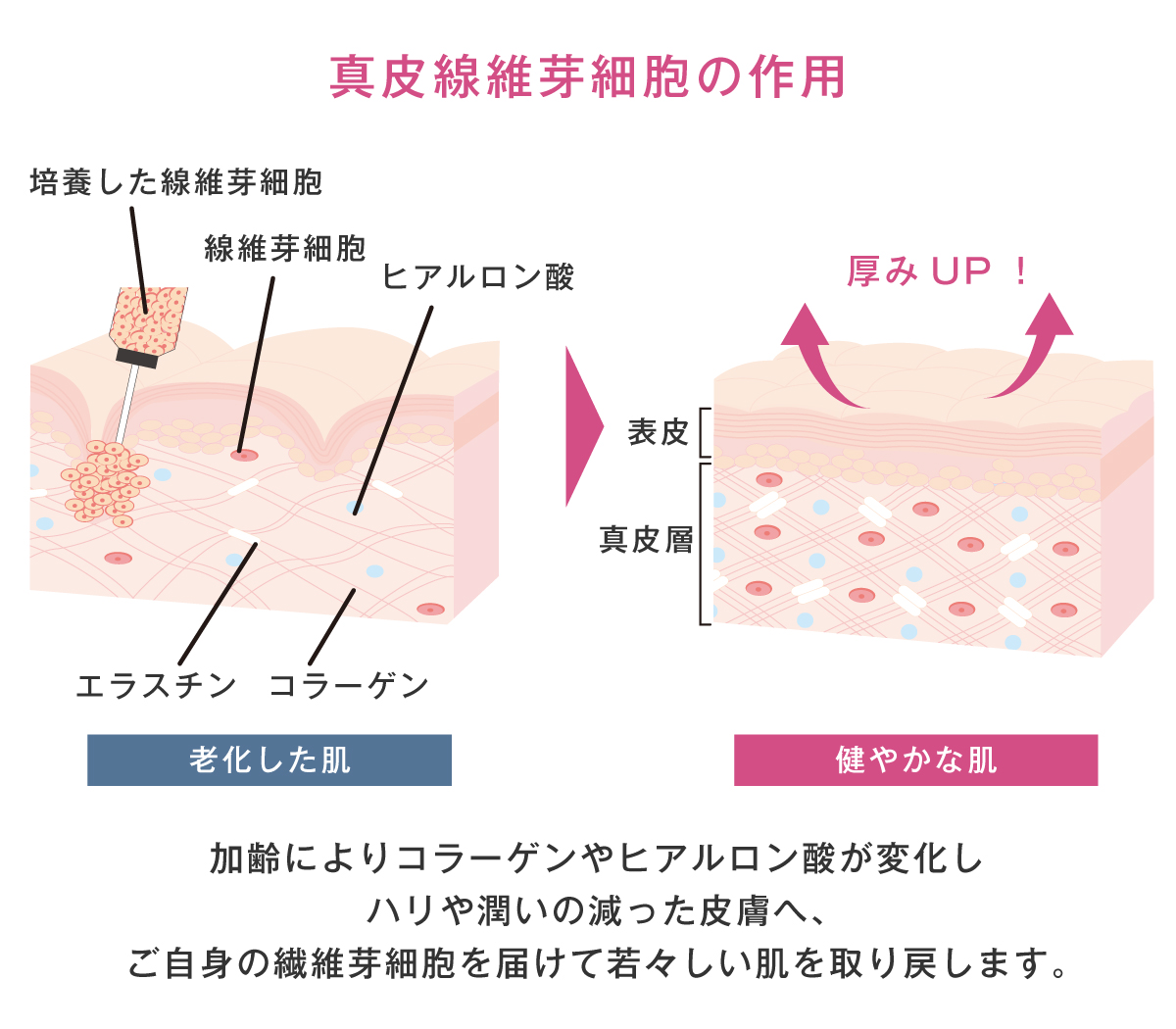 真皮線維芽細胞療法の仕組み