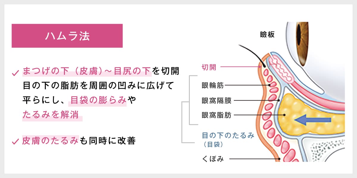 ハムラ法