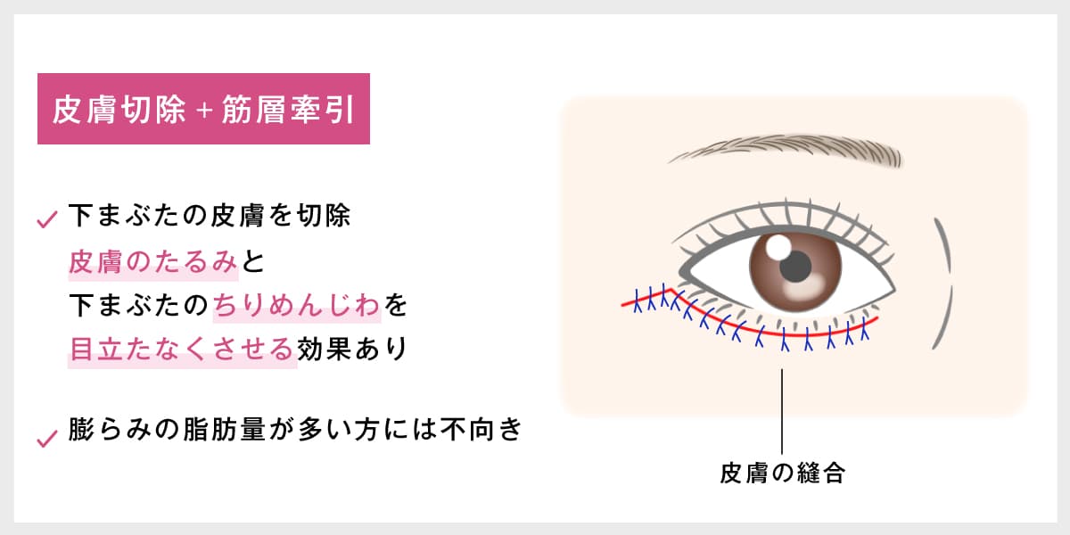 皮膚切除＋筋層牽引