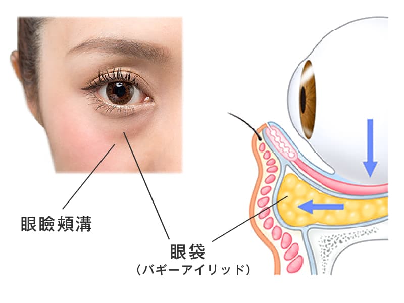 眼瞼頬溝と眼袋