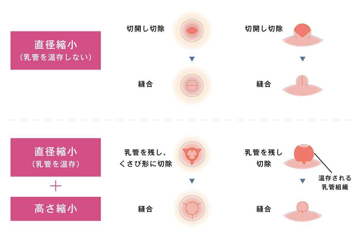 乳頭縮小術