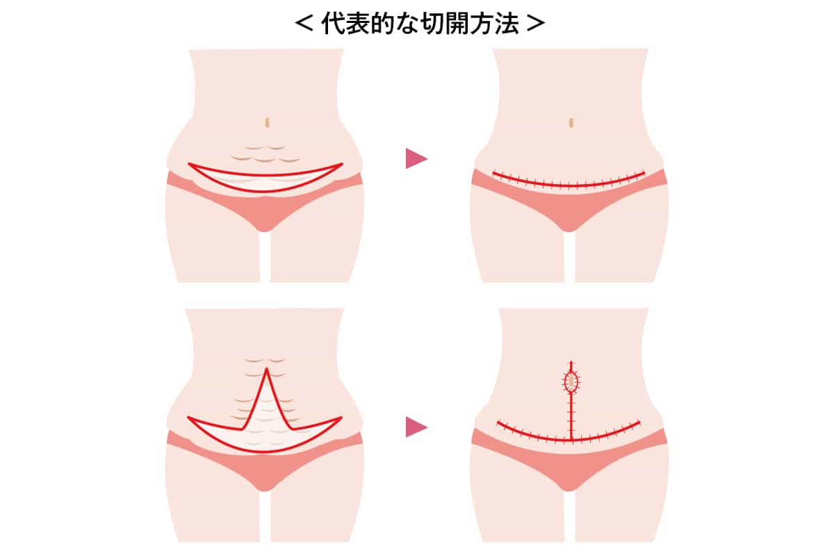 タミータックの代表的な切開方法の説明図