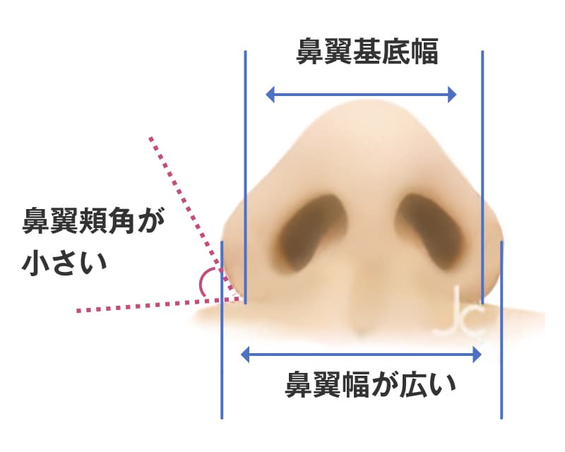 鼻幅のバランスの解説イラスト。鼻翼頬角が小さく、鼻翼幅が広い